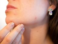 Toothpaste on pimple (Image via Getty Images)